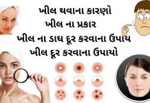ખીલ દૂર કરવાના ઉપાયો - khil dur karvana upay - ખીલ કાઢવાના ઉપાય - ખીલ દૂર કરવા માટે ના ઉપાય - ખીલ ની દવા - khil ni dava - khil matadava ni dava - ખીલ થવાના કારણો - ખીલ નો ઉપચાર - khil na gharelu upchar - ખીલ ના પ્રકાર - ખીલ ના ડાઘ દૂર કરવાના ઉપાય - khil na dag dur karvana upay