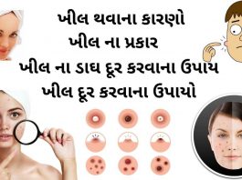 ખીલ દૂર કરવાના ઉપાયો - khil dur karvana upay - ખીલ કાઢવાના ઉપાય - ખીલ દૂર કરવા માટે ના ઉપાય - ખીલ ની દવા - khil ni dava - khil matadava ni dava - ખીલ થવાના કારણો - ખીલ નો ઉપચાર - khil na gharelu upchar - ખીલ ના પ્રકાર - ખીલ ના ડાઘ દૂર કરવાના ઉપાય - khil na dag dur karvana upay