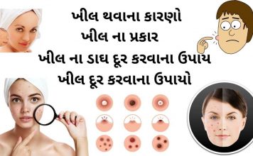 ખીલ દૂર કરવાના ઉપાયો - khil dur karvana upay - ખીલ કાઢવાના ઉપાય - ખીલ દૂર કરવા માટે ના ઉપાય - ખીલ ની દવા - khil ni dava - khil matadava ni dava - ખીલ થવાના કારણો - ખીલ નો ઉપચાર - khil na gharelu upchar - ખીલ ના પ્રકાર - ખીલ ના ડાઘ દૂર કરવાના ઉપાય - khil na dag dur karvana upay