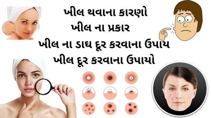 ખીલ દૂર કરવાના ઉપાયો - khil dur karvana upay - ખીલ કાઢવાના ઉપાય - ખીલ દૂર કરવા માટે ના ઉપાય - ખીલ ની દવા - khil ni dava - khil matadava ni dava - ખીલ થવાના કારણો - ખીલ નો ઉપચાર - khil na gharelu upchar - ખીલ ના પ્રકાર - ખીલ ના ડાઘ દૂર કરવાના ઉપાય - khil na dag dur karvana upay