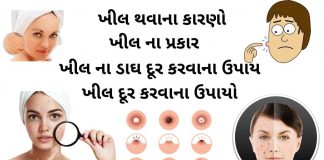 ખીલ દૂર કરવાના ઉપાયો - khil dur karvana upay - ખીલ કાઢવાના ઉપાય - ખીલ દૂર કરવા માટે ના ઉપાય - ખીલ ની દવા - khil ni dava - khil matadava ni dava - ખીલ થવાના કારણો - ખીલ નો ઉપચાર - khil na gharelu upchar - ખીલ ના પ્રકાર - ખીલ ના ડાઘ દૂર કરવાના ઉપાય - khil na dag dur karvana upay