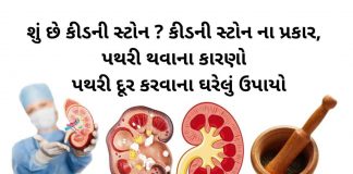 પથરી દૂર કરવાના ઉપાયો - કિડની સ્ટોન - પથરીની સારવાર - પથરી ના ઉપાય - પથરી ની દવા - કિડનીની પથરી ની દવા - pathari in gujarati - pathari mate dava -pathari ni dava gujarati ma
