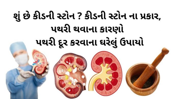 પથરી દૂર કરવાના ઉપાયો - કિડની સ્ટોન - પથરીની સારવાર - પથરી ના ઉપાય - પથરી ની દવા - કિડનીની પથરી ની દવા - pathari in gujarati - pathari mate dava -pathari ni dava gujarati ma